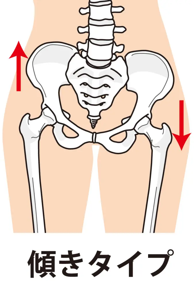 知られざる整体の骨盤矯正の効果とは？ | 松山市の整体 | 愛YOUカイロ