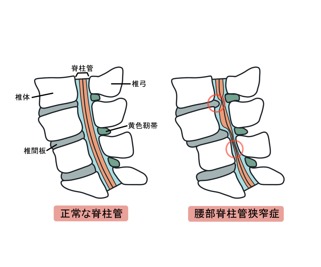 正常な脊柱管と腰部脊柱管狭窄症